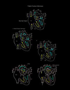 Patent Ductus Arteriosus illustration