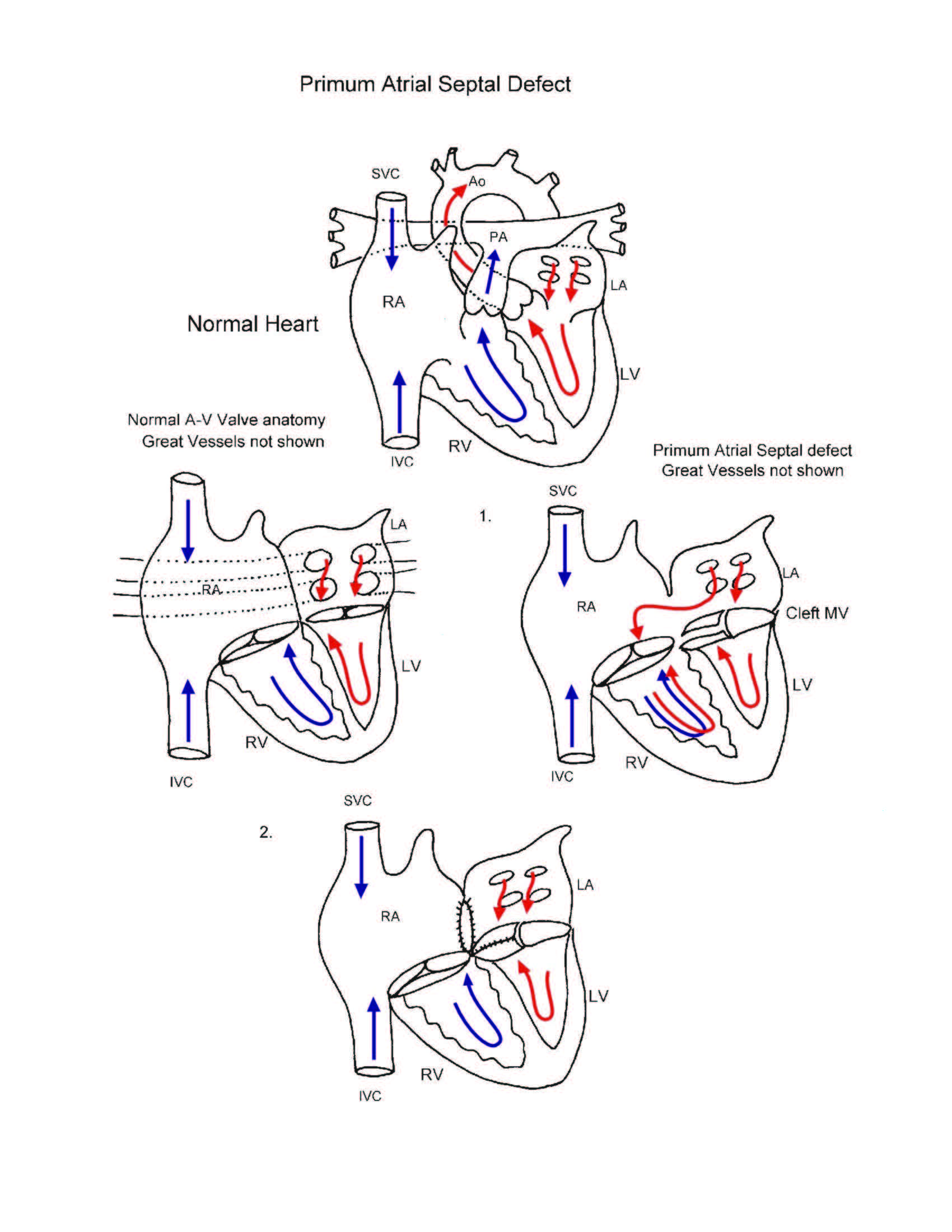 Primum Atrial Septal Defect illustration