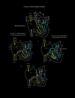 Primum Atrial Septal Defect illustration