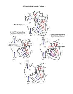 Primum Atrial Septal Defect illustration