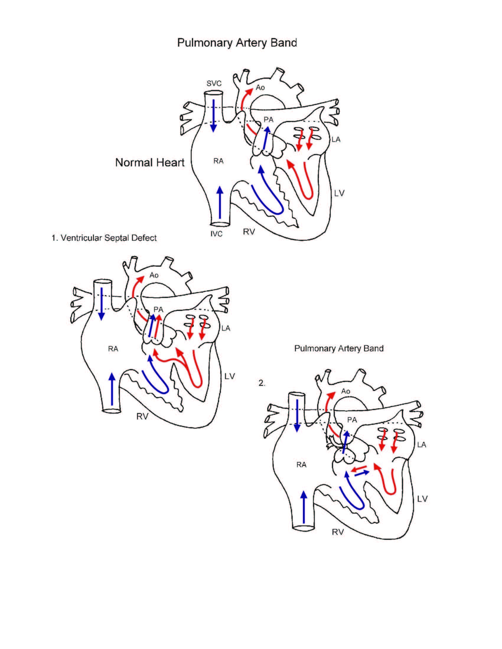 Pulmonary Artery Band illustration