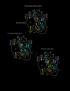 Pulmonary Artery Band illustration