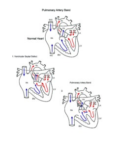 Pulmonary Artery Band illustration