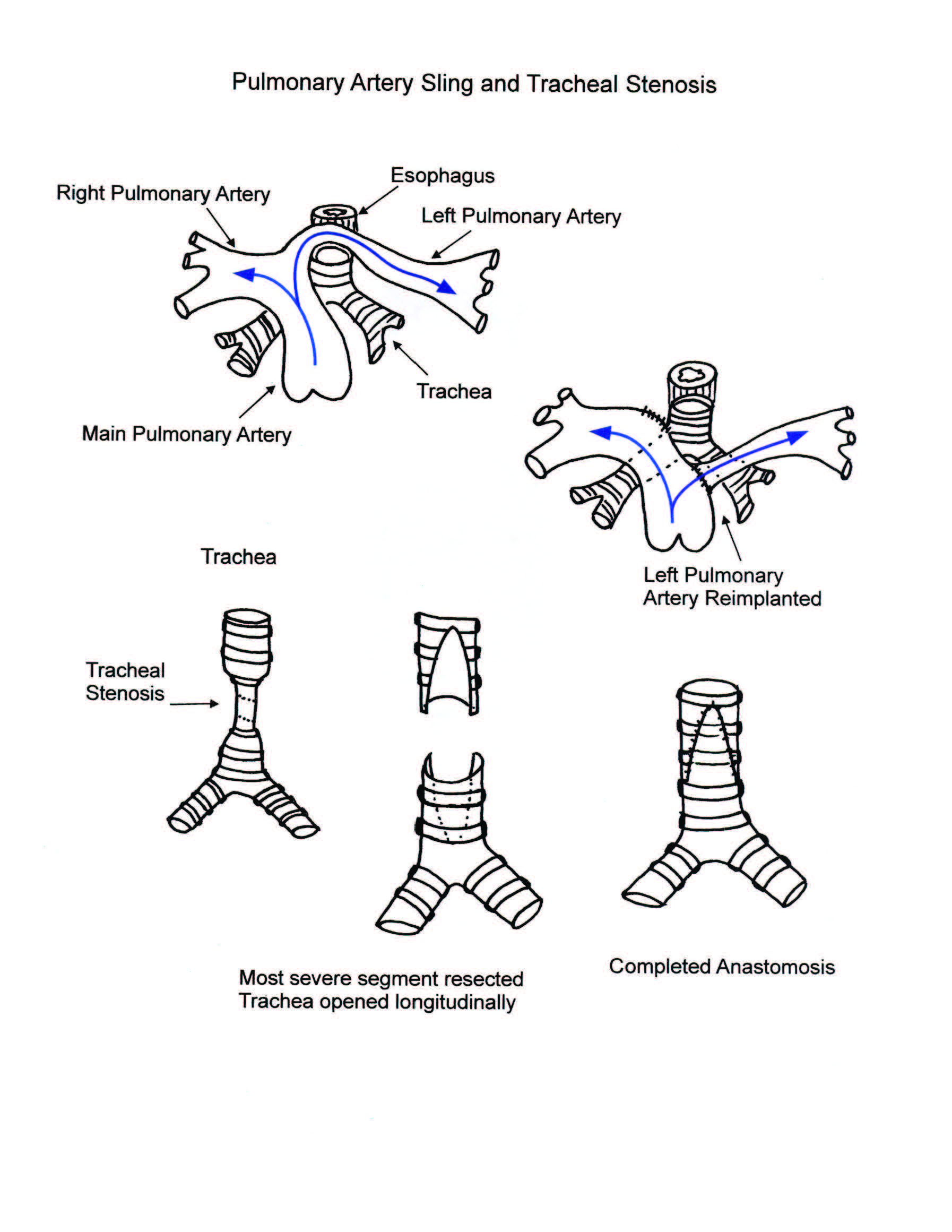 Pulmonary Artery Sling and Tracheal Stenosis illustration