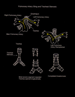Pulmonary Artery Sling and Tracheal Stenosis illustration