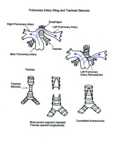 Pulmonary Artery Sling and Tracheal Stenosis illustration