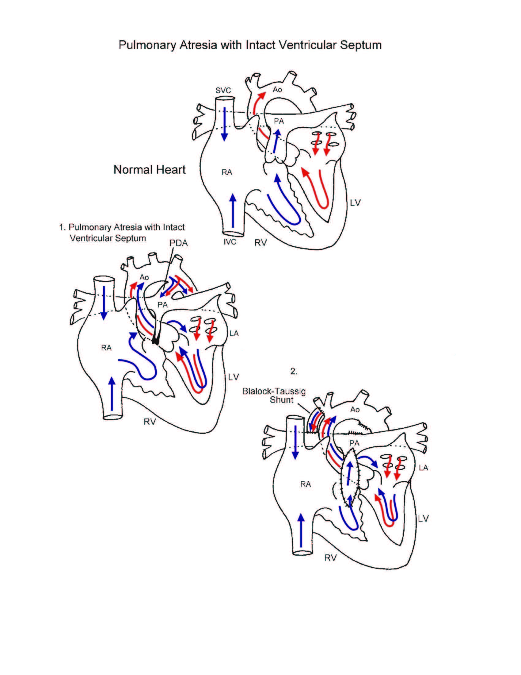 Pulmonary Atresia with Intact Ventricular Septum illustration