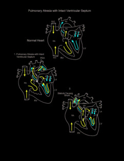 Pulmonary Atresia with Intact Ventricular Septum illustration