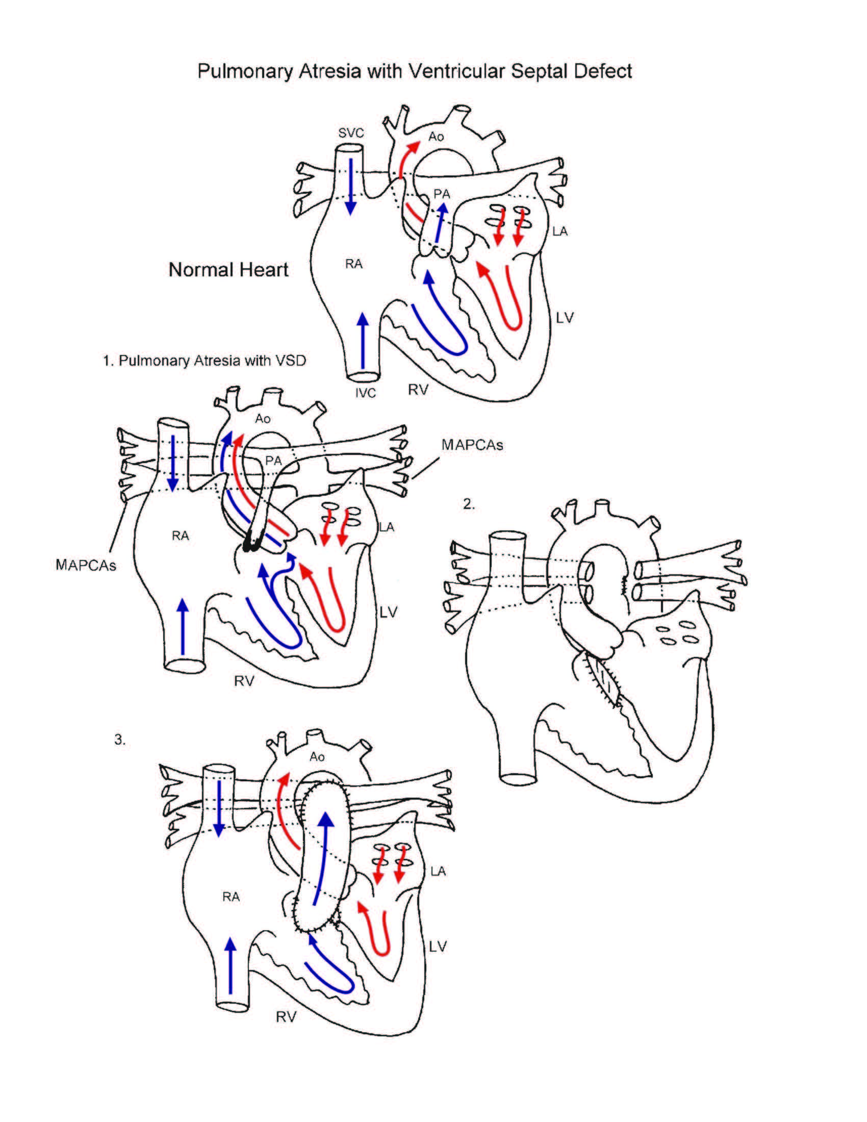 Pulmonary atresia with ventricular septal defect illustration