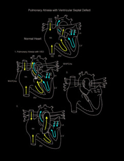 Pulmonary atresia with ventricular septal defect illustration