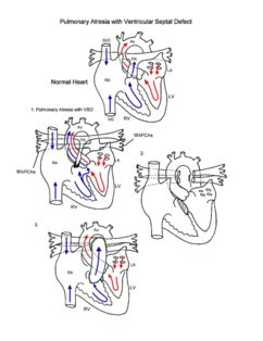 Pulmonary atresia with ventricular septal defect illustration