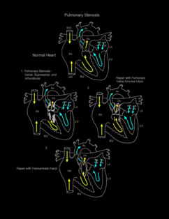 Pulmonary stenosis illustration