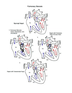 Pulmonary stenosis illustration
