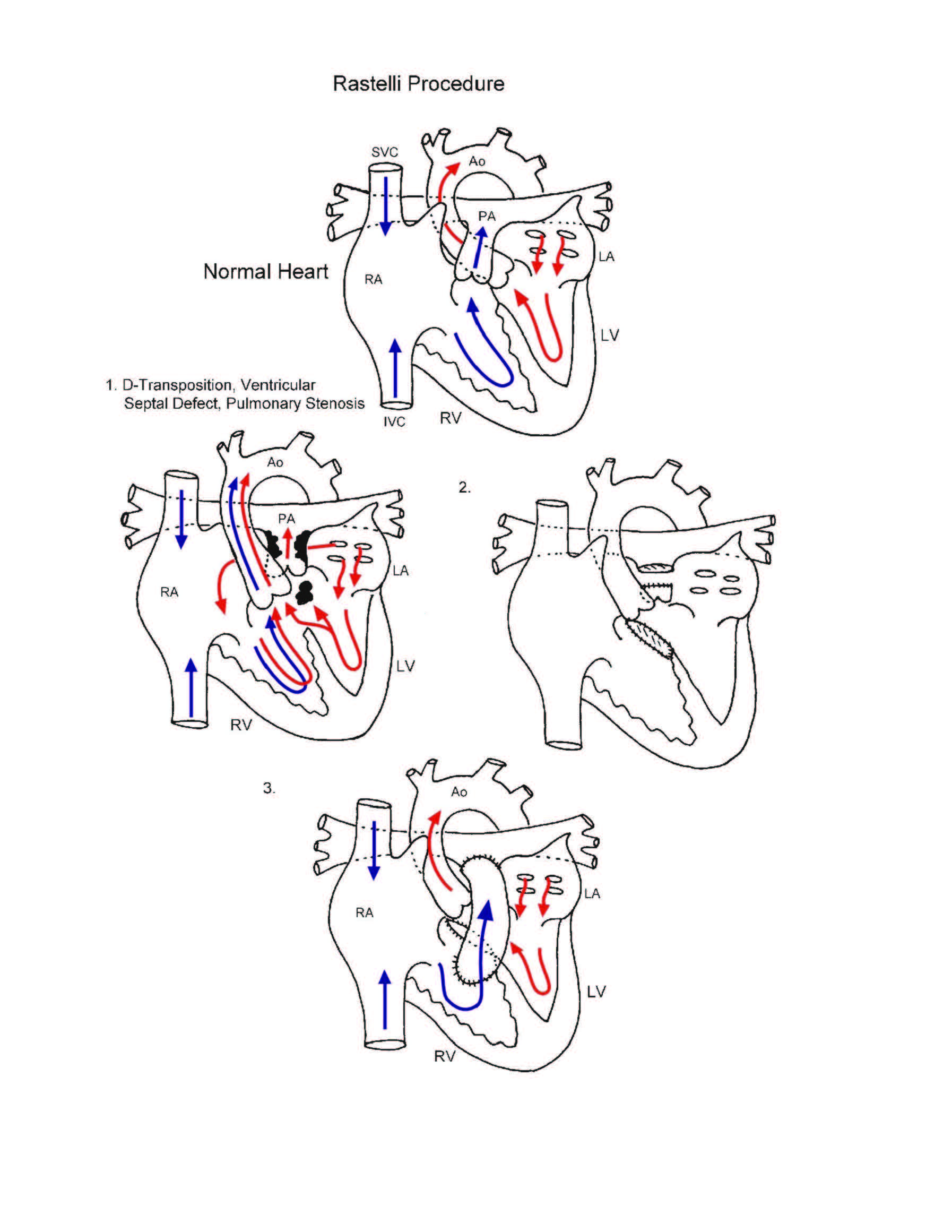 Rastelli procedure illustration