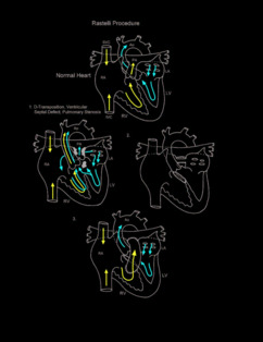 Rastelli procedure illustration