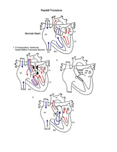 Rastelli procedure illustration