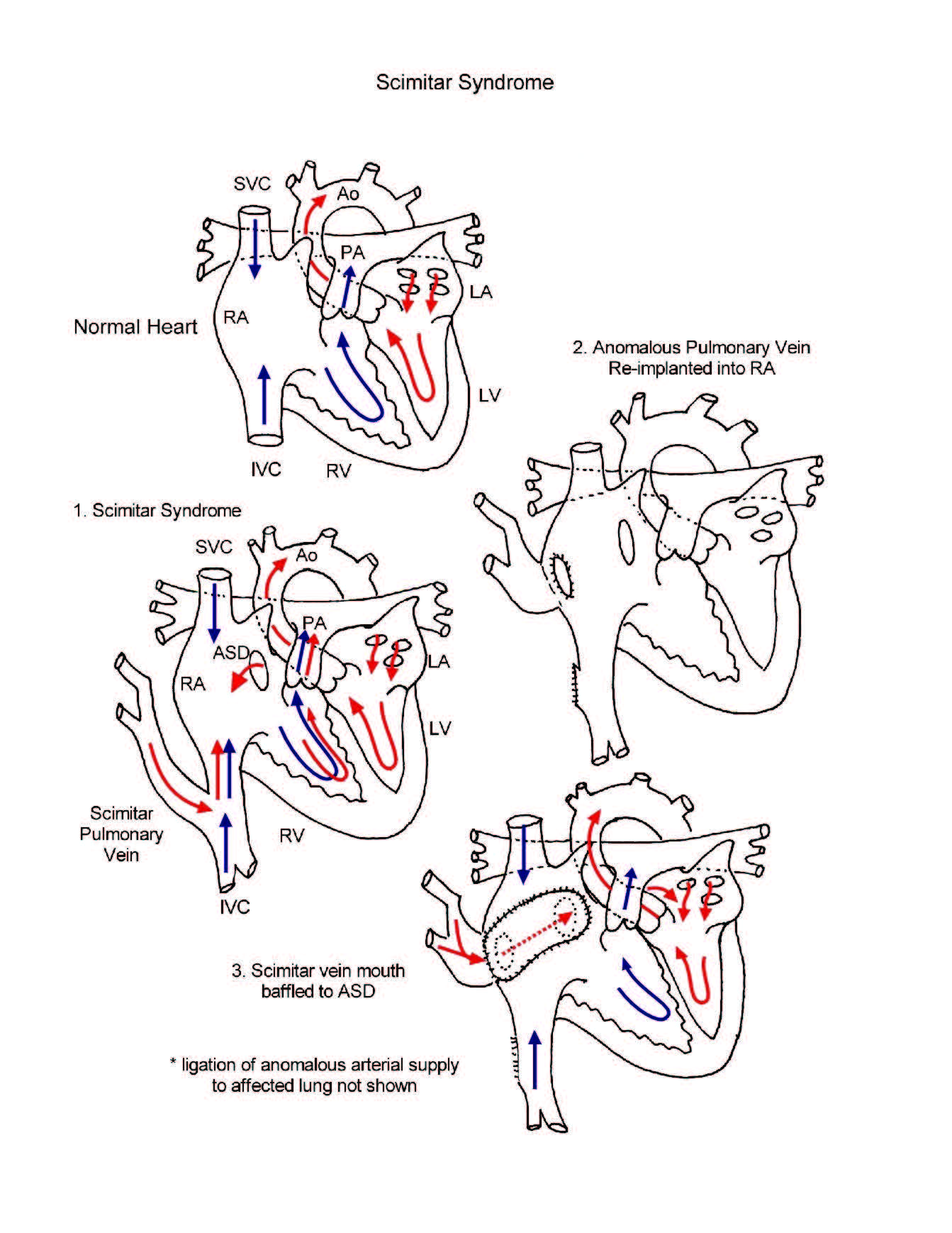 Scimitar syndrome illustration