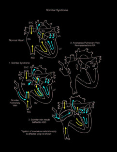 Scimitar syndrome illustration