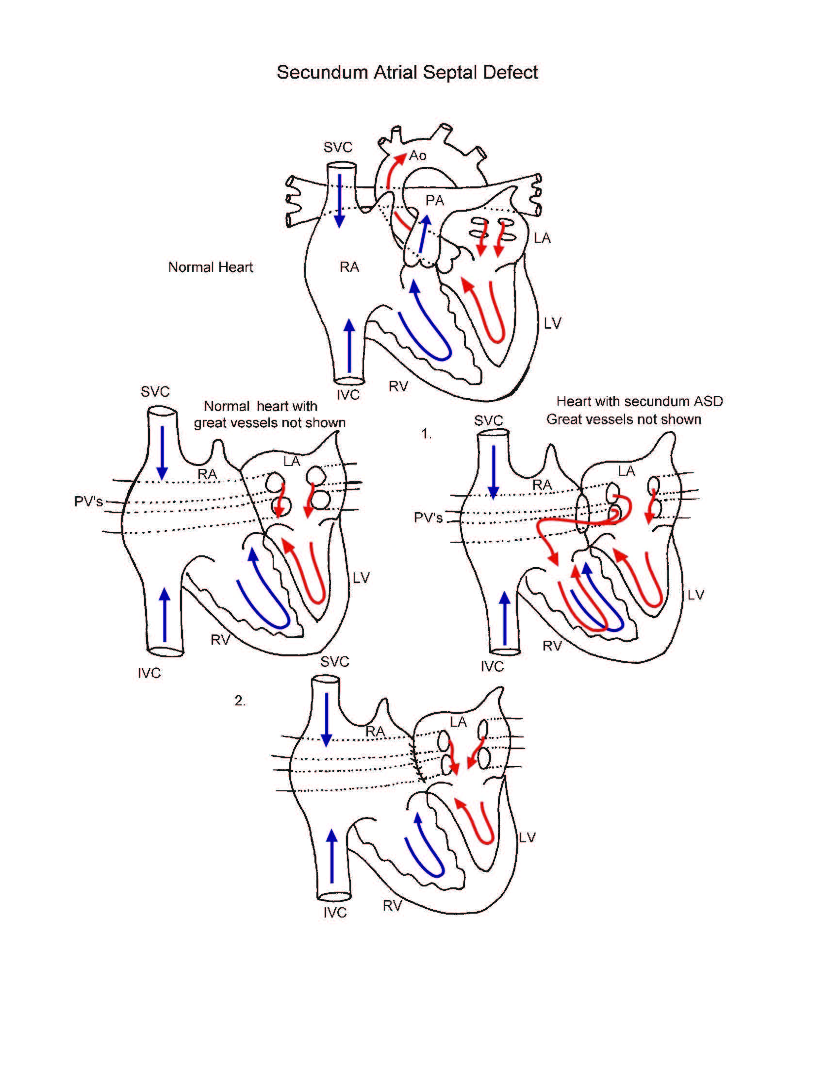 Secundum Atrial Septal Defect illustration