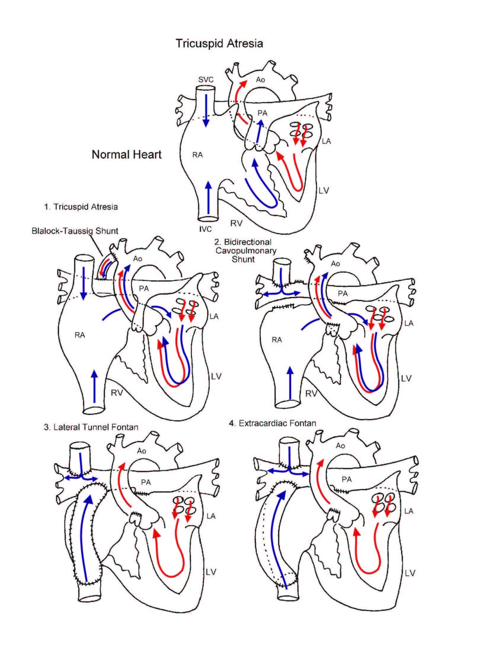 Tricuspid Atresia illustration