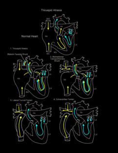 Tricuspid Atresia illustration