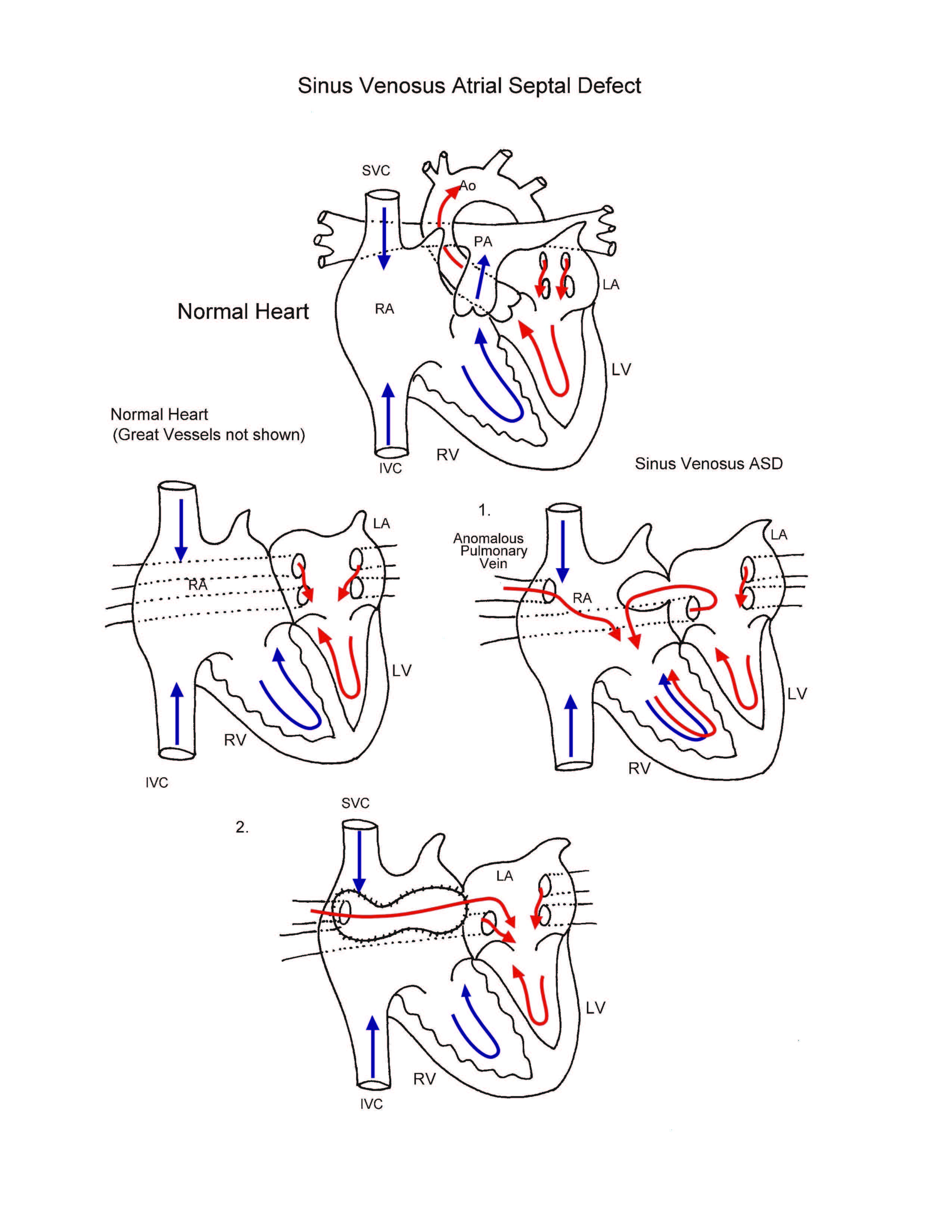 Sinus Venosus Atrial Septal Defect illustration