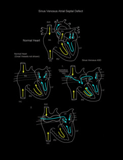 Sinus Venosus Atrial Septal Defect illustration