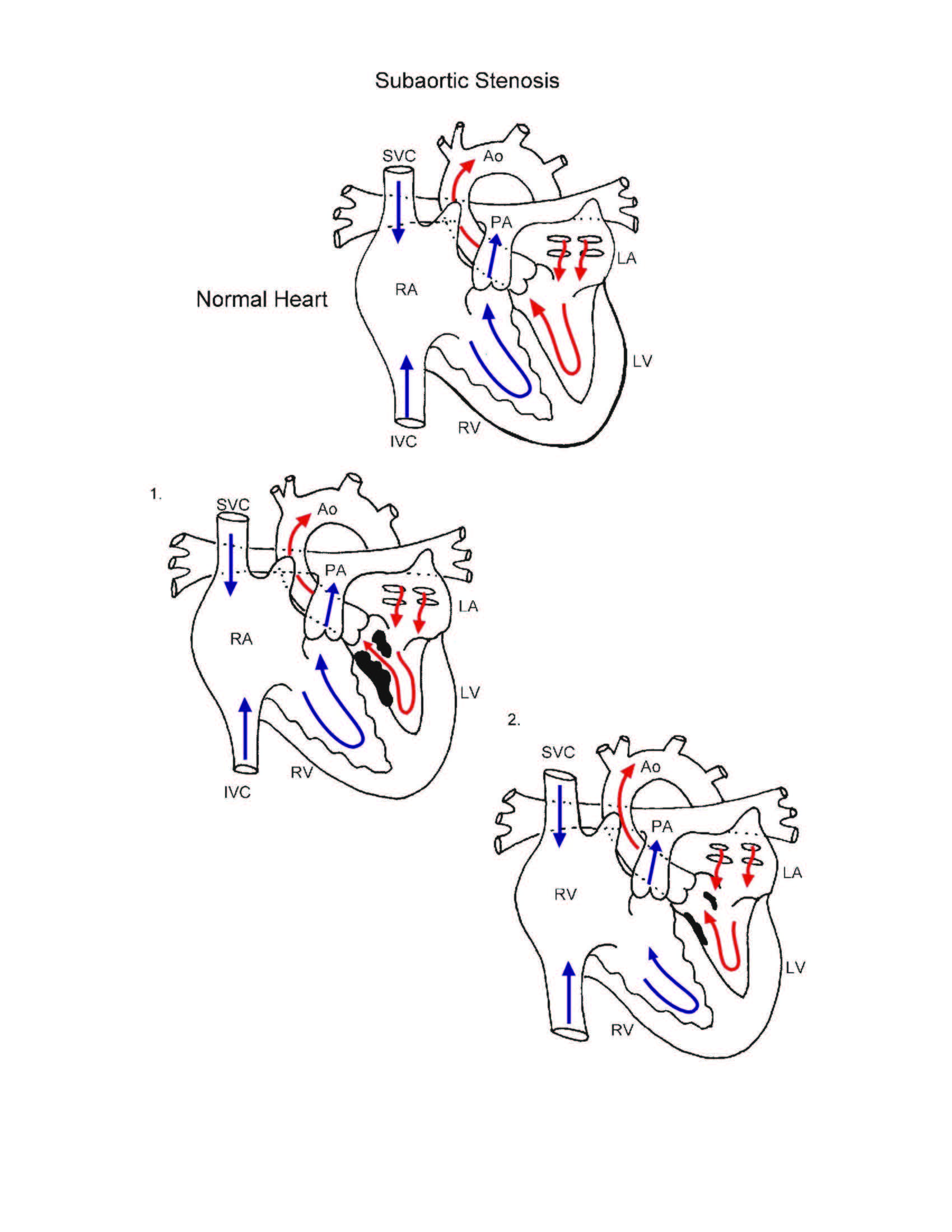 Subaortic Stenosis illustration