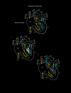 Subaortic Stenosis illustration