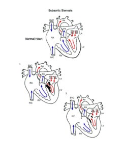 Subaortic Stenosis illustration