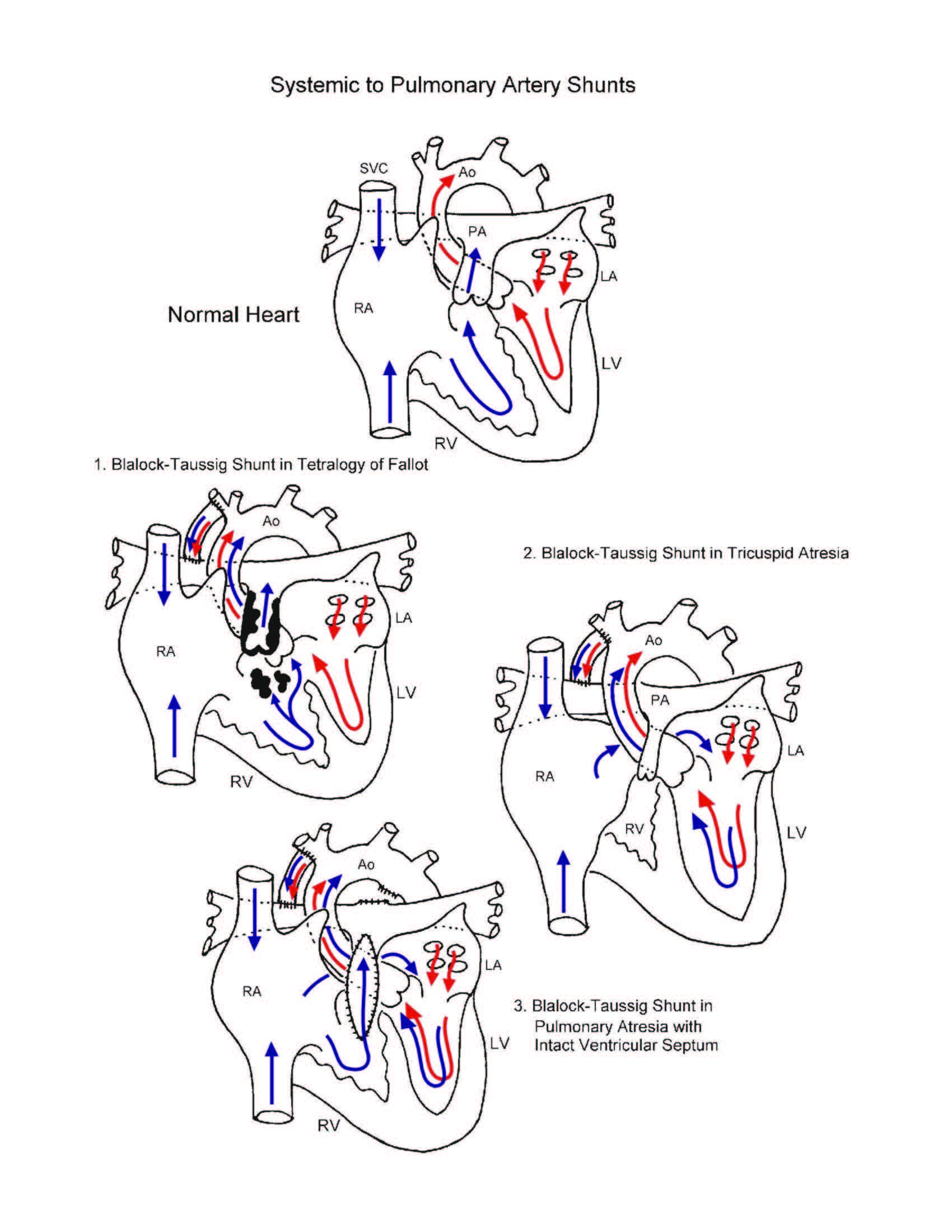 Systemic to Pulmonary Artery Shunts illustration