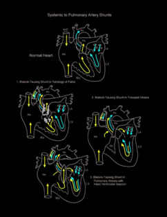 Systemic to Pulmonary Artery Shunts illustration