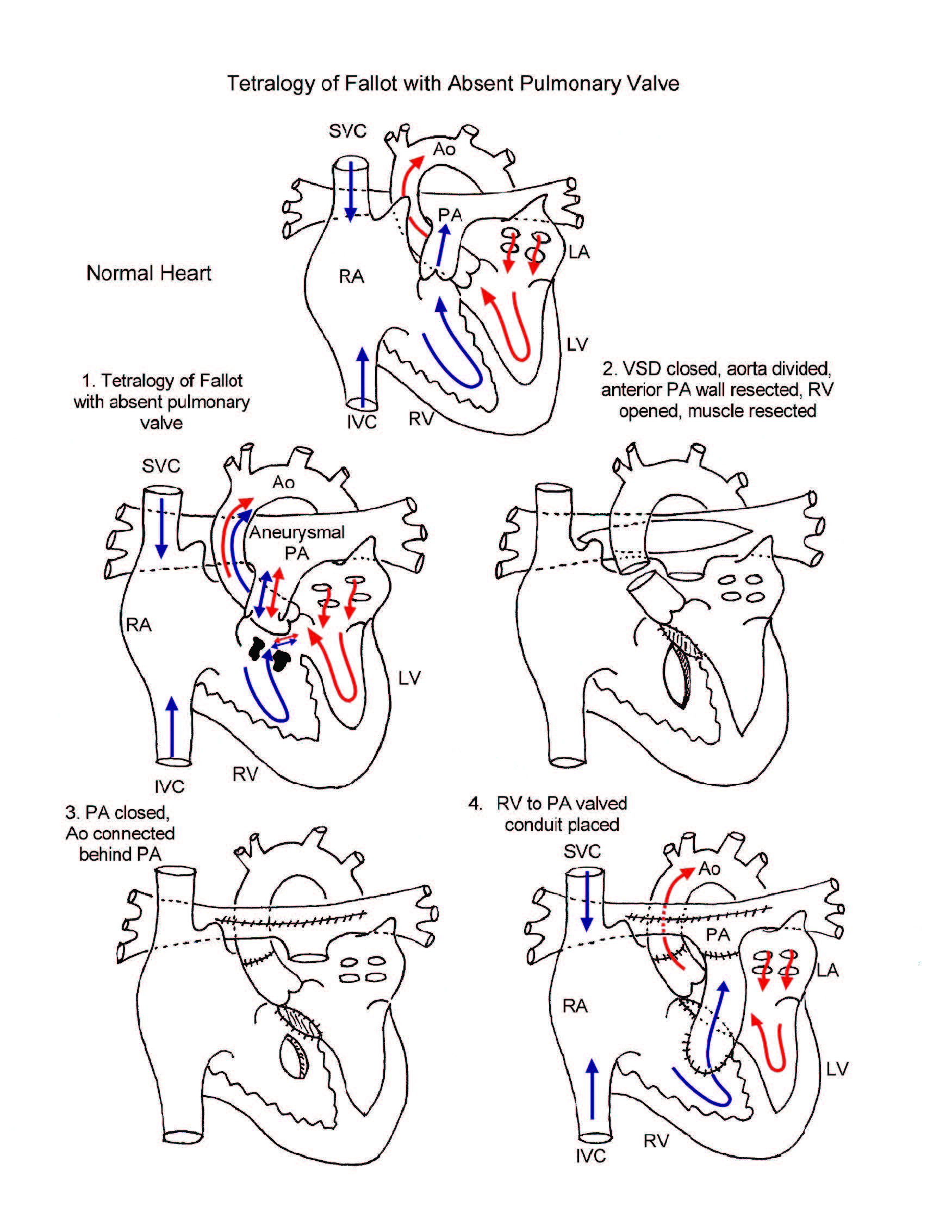 Tetralogy of Fallot with Absent Pulmonary Valve illustration