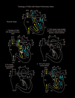 Tetralogy of Fallot with Absent Pulmonary Valve illustration