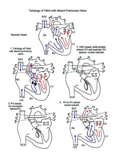 Tetralogy of Fallot with Absent Pulmonary Valve illustration