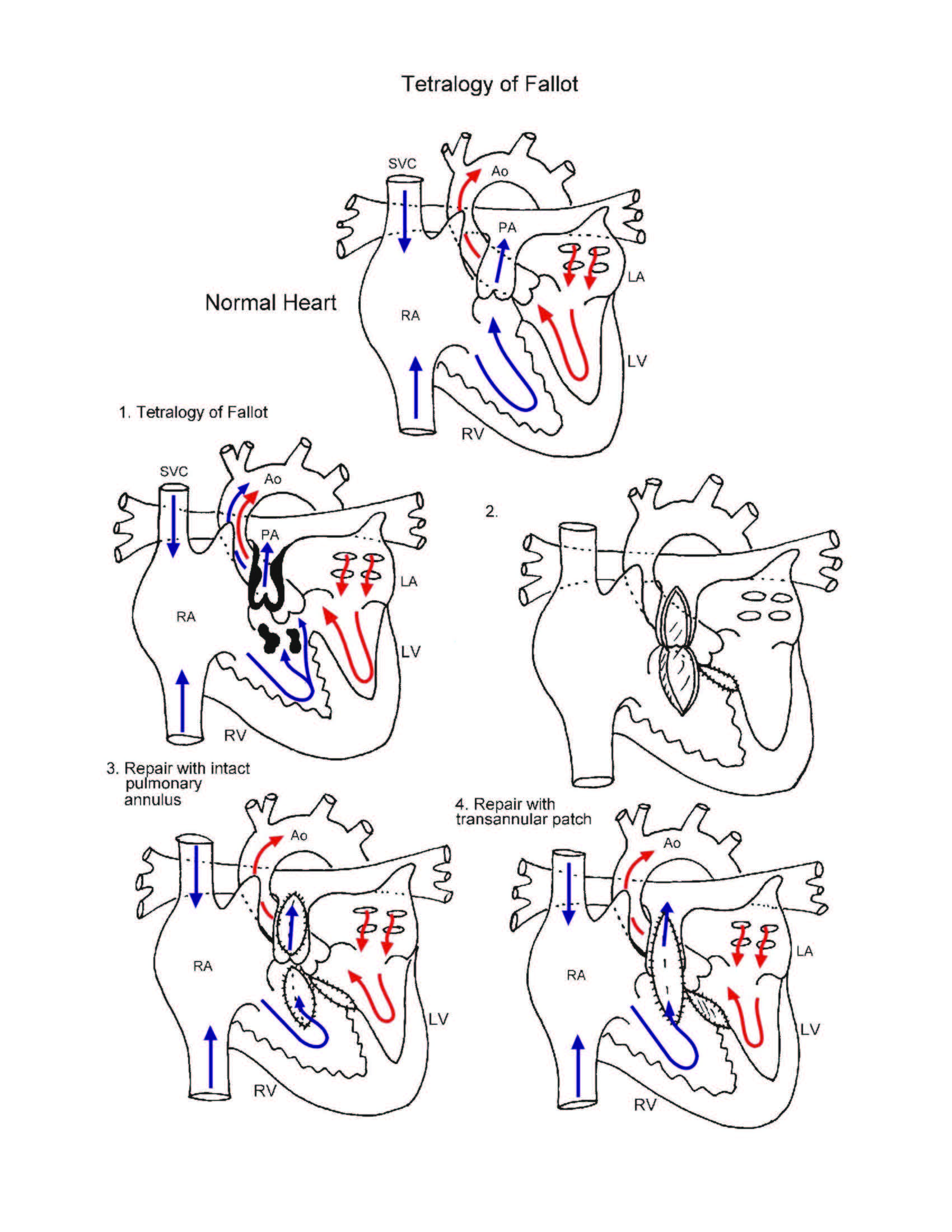 Tetralogy of Fallot illustration