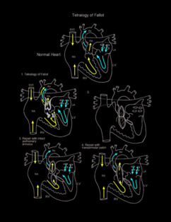 Tetralogy of Fallot illustration