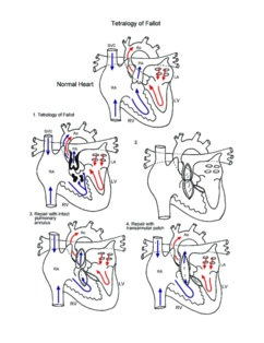 Tetralogy of Fallot illustration