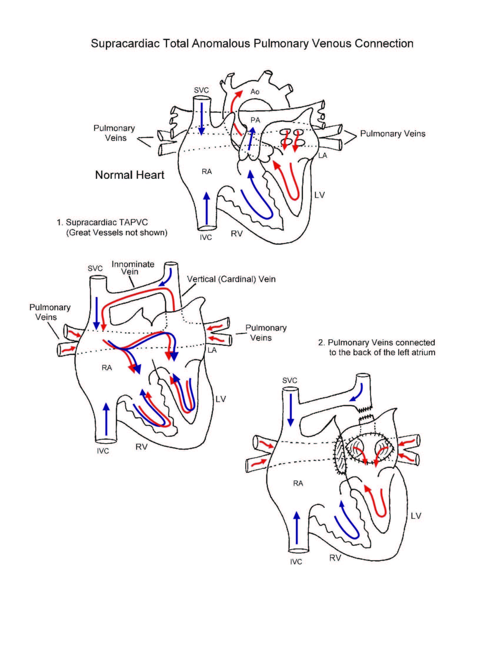 Total Pulmonary Venous Connection illustration 1