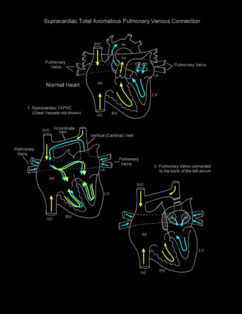 Total Pulmonary Venous Connection illustration 1