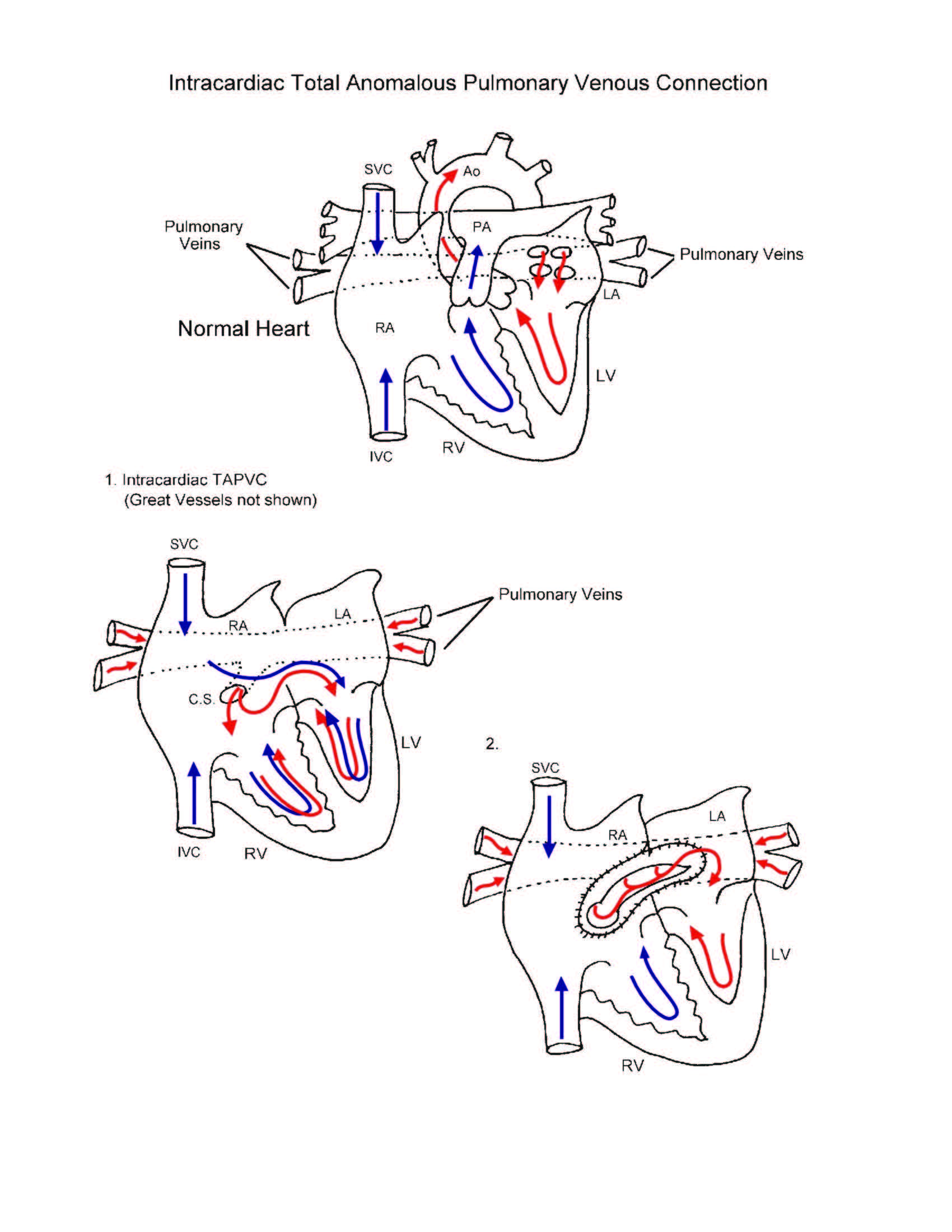Total Pulmonary Venous Connection illustration 2