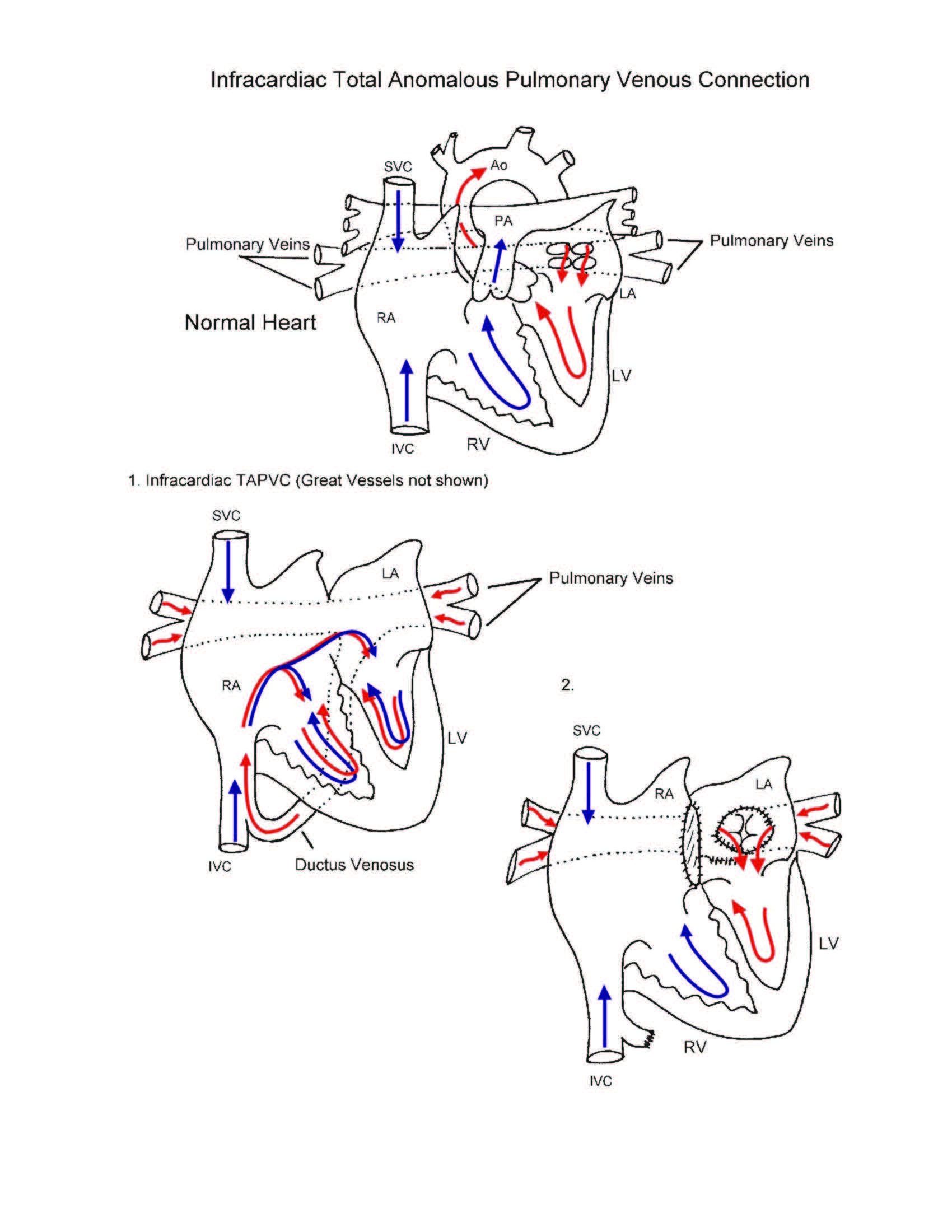 Total Pulmonary Venous Connection illustration 3