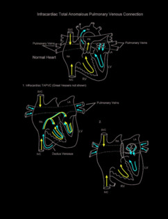 Total Pulmonary Venous Connection illustration 3