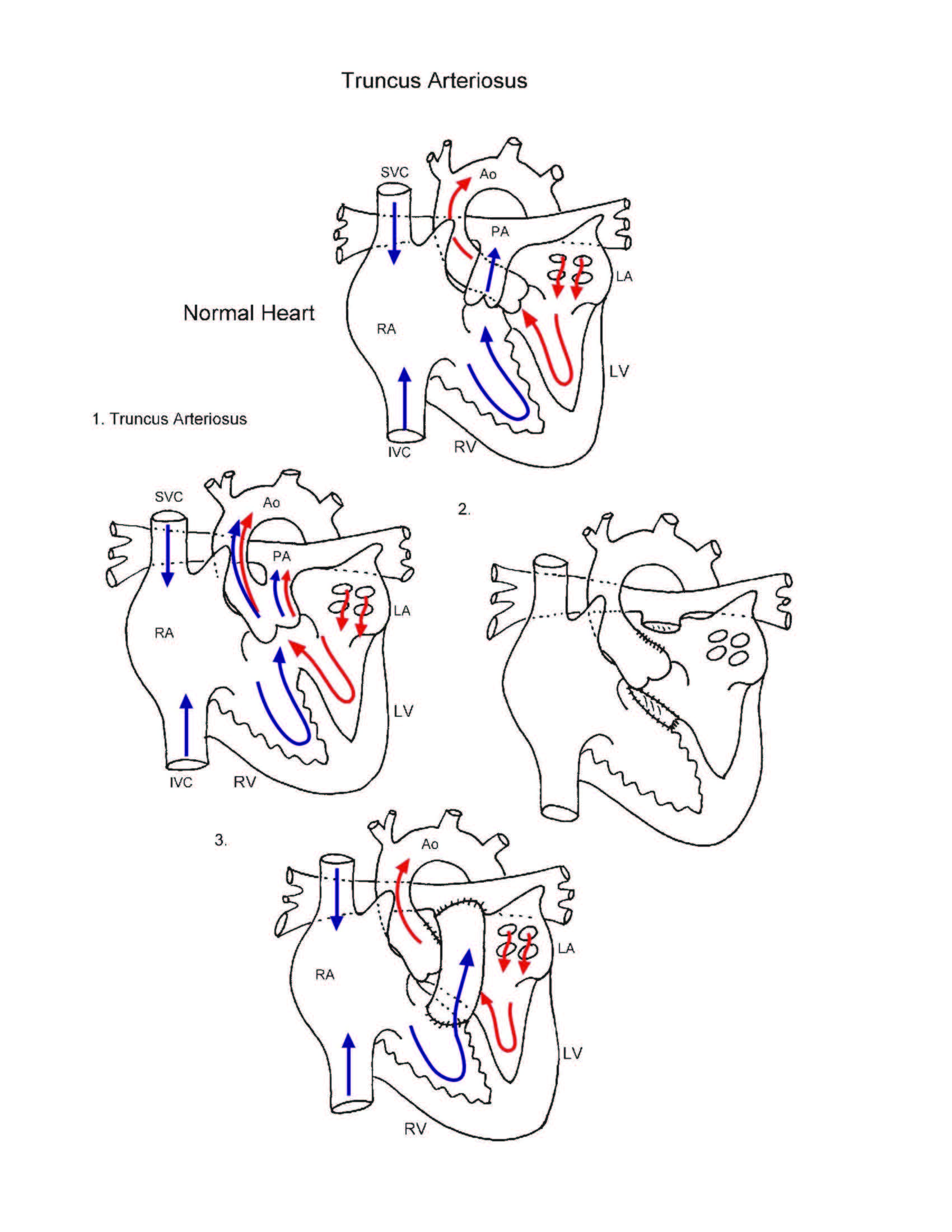 Truncus Arteriosus illustration