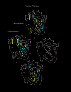 Truncus Arteriosus illustration