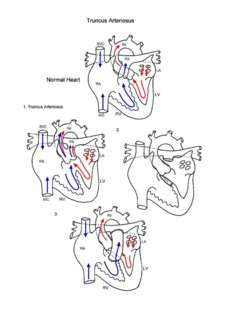 Truncus Arteriosus illustration