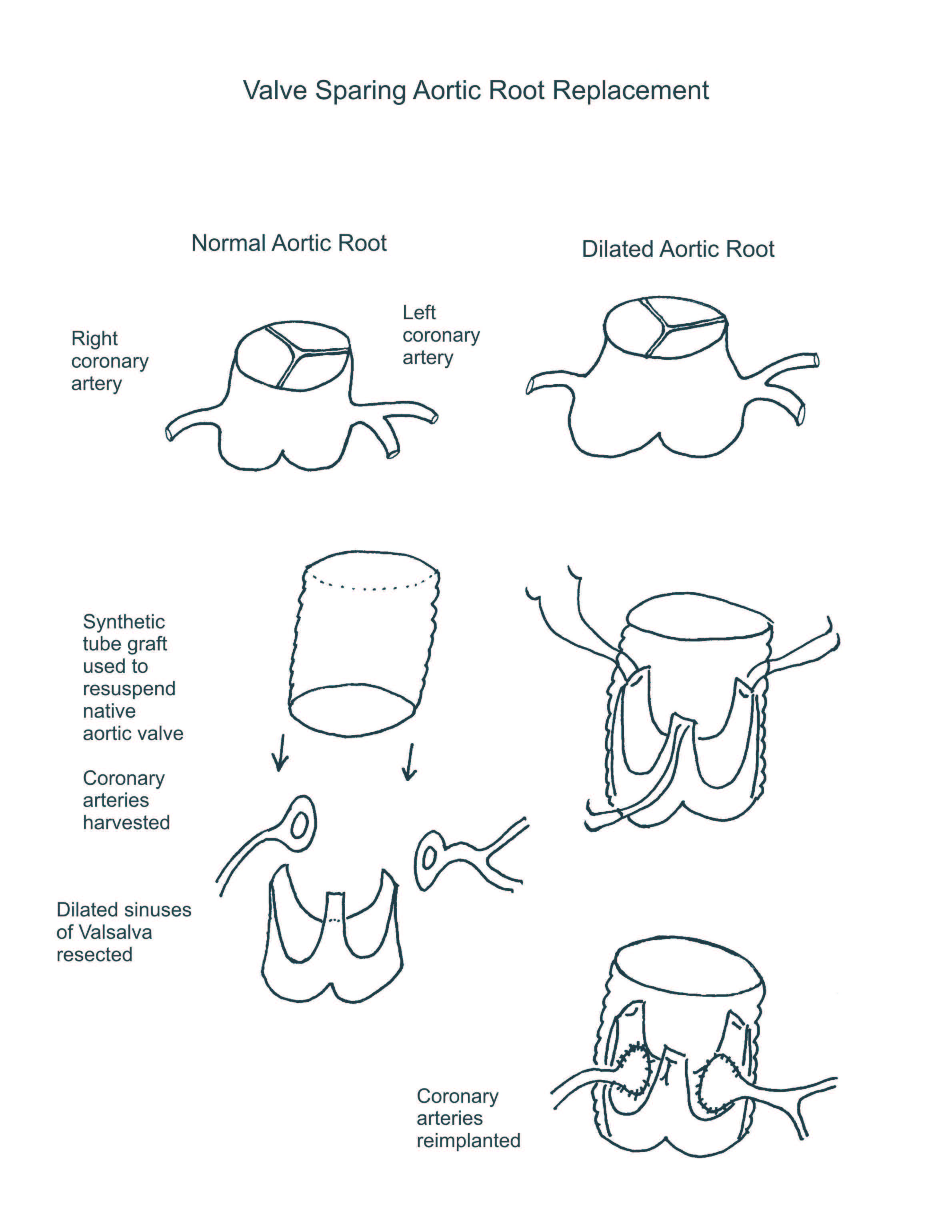 Valve Sparing Aortic Root Replacement illustration