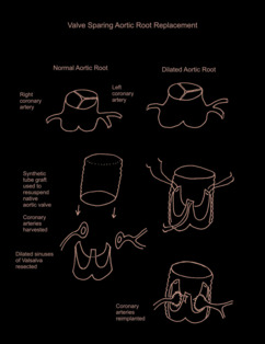 Valve Sparing Aortic Root Replacement illustration