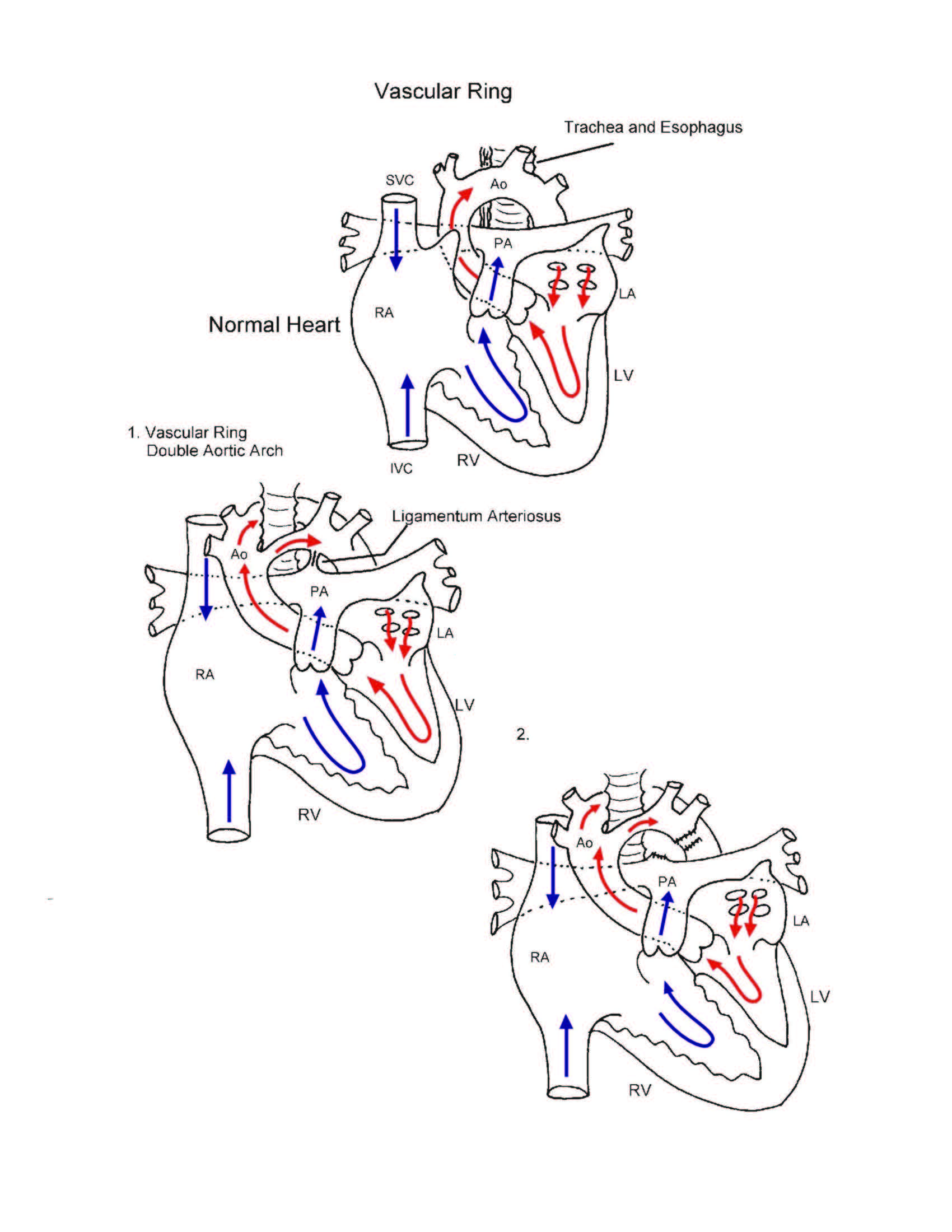 Vascular Ring illustration