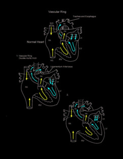 Vascular Ring illustration